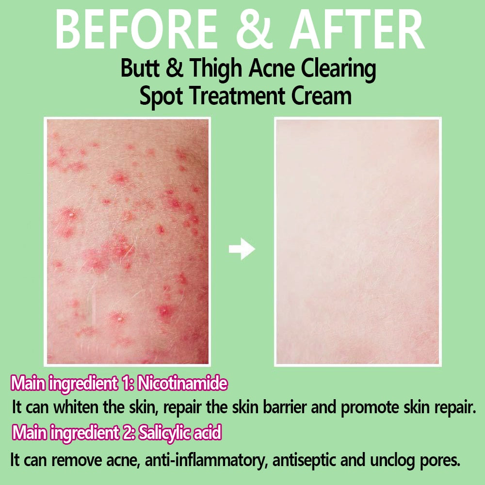 Butt Acne Clearing Spot Treatment Cream - wonderfulandamazingstuff