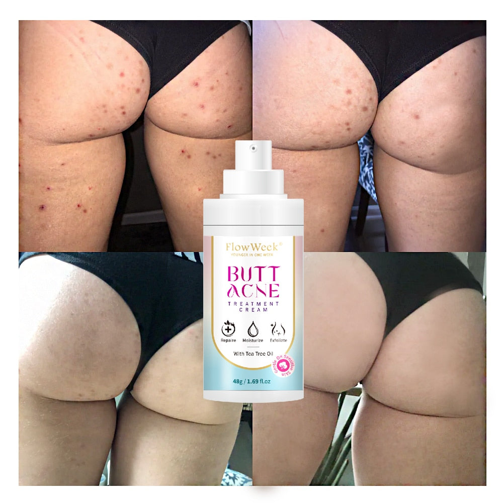 Butt Acne Clearing Spot Treatment Cream - wonderfulandamazingstuff