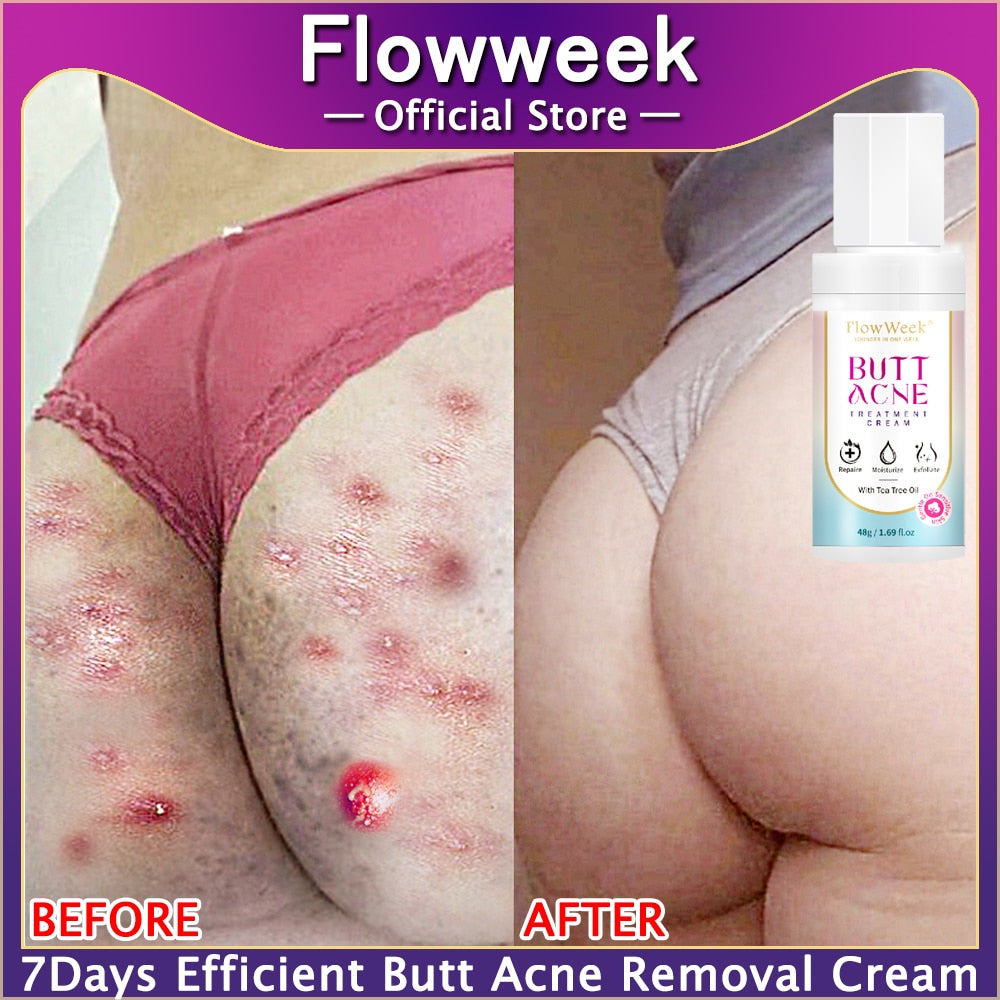 Butt Acne Clearing Spot Treatment Cream - wonderfulandamazingstuff